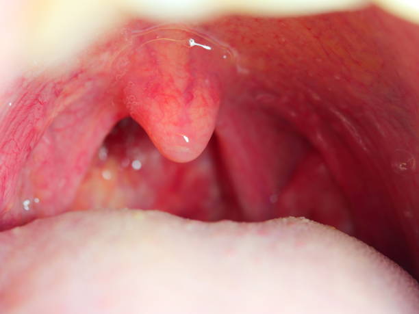 tonsilite infezione gola ha aperto bocca gola tonsille - ugola foto e immagini stock
