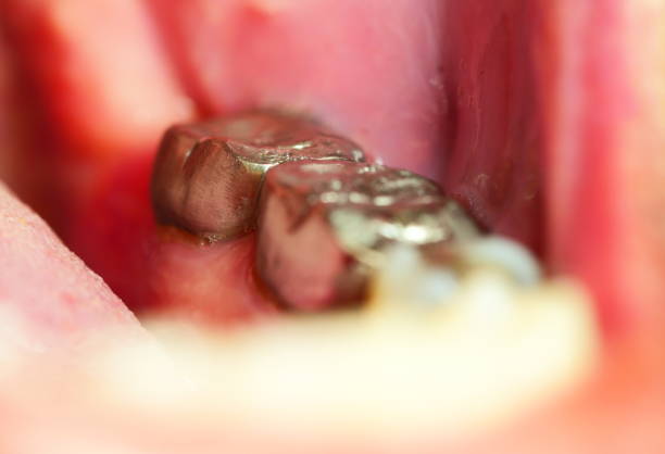 istock Restoration of teeth after endodontic treatment 1144604992
