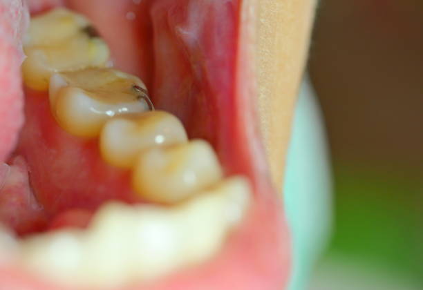 istock Dental caries. Filling with dental composite 1144604998
