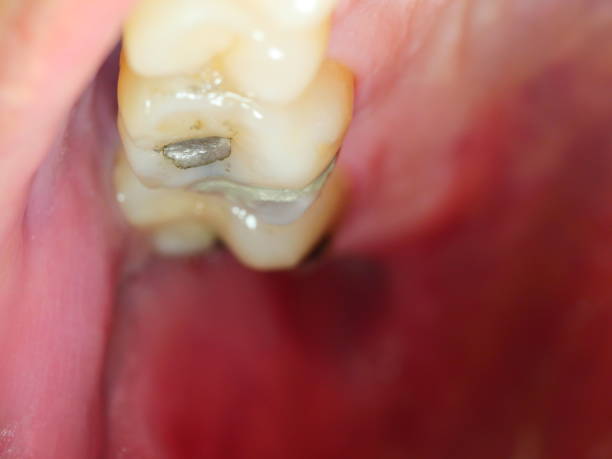 istock Restoration of teeth after endodontic treatment 1144605112