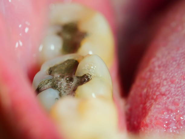 istock Restoration of teeth after endodontic treatment 1144605140
