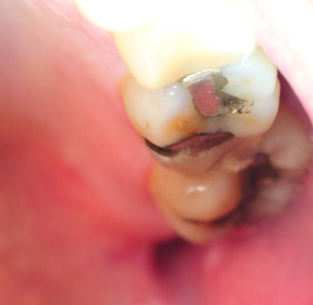 istock Metall dental fillings, 1144605164