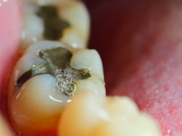 istock Dental caries. Filling with dental composite 1144605186