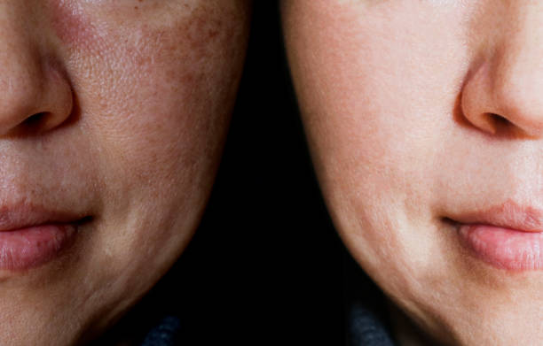 istock Face with open pores and melasma before and after make up or treatment concept. 1144677256