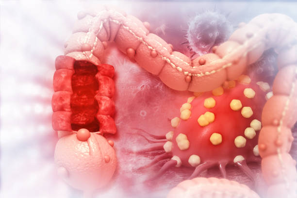 istock Colon cancer. Cancer attacking cell. Colon disease concept 1144973050