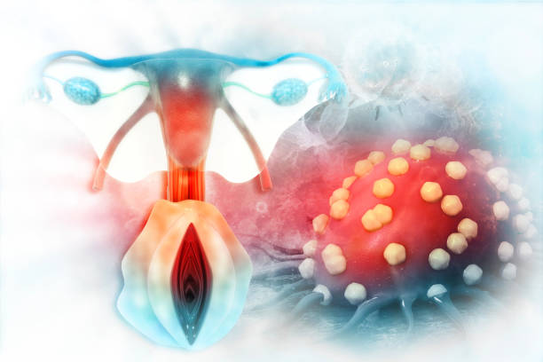istock uterine cancer 3d render 1144974709