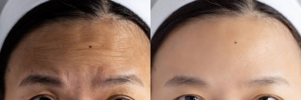forehead wrinkles problem. pictures compared effect Before and After treatment for forehead wrinkles skin problem in woman to solve skin problem for better skin result forehead wrinkles problem. pictures compared effect Before and After treatment for forehead wrinkles skin problem in woman to solve skin problem for better skin result botox before and after stock pictures, royalty-free photos & images