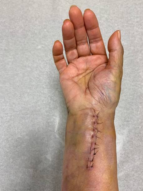istock Senior Woman’s Wrist After Surgery 1145029120