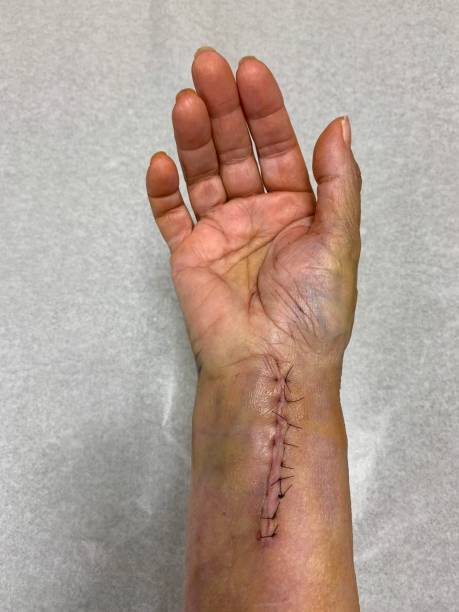 istock Senior Woman’s Wrist After Surgery 1145029153