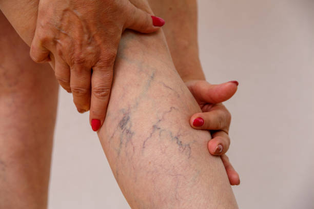 oudere vrouw toont spat - woman legs veins stockfoto's en -beelden