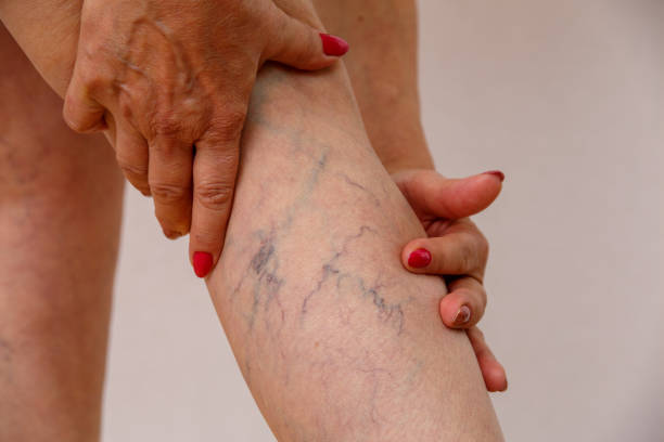 elderly woman shows varicose - leg imagens e fotografias de stock