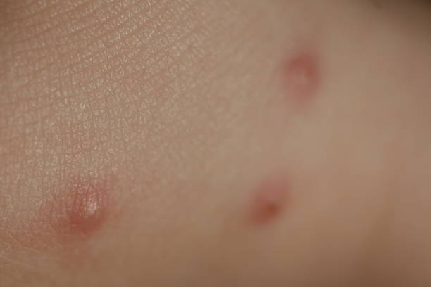 insect bites on  skin  child stock photo