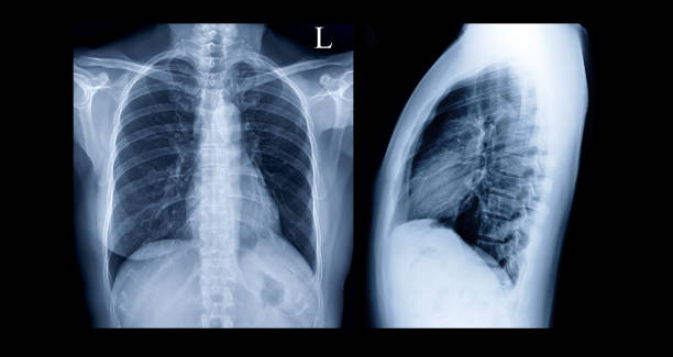 comparison of chest x-ray pa and lateral view or x-ray image of human chest  for screening heart disease and lung disease . - pain rib cage x ray image chest imagens e fotografias de stock