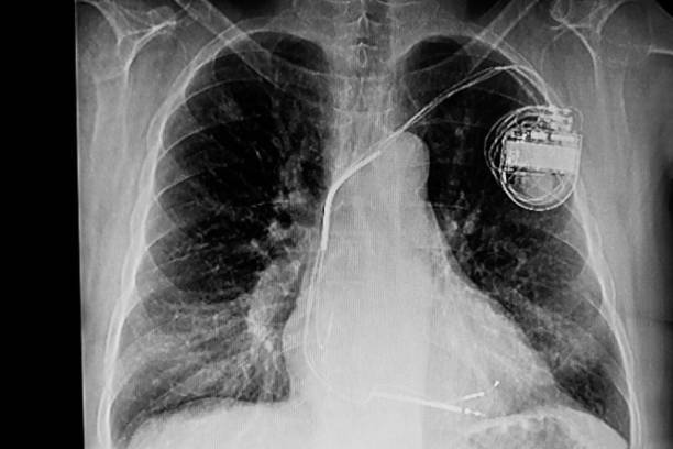 istock Chest X- Ray of a male patient with heart pacemaker 1145702353