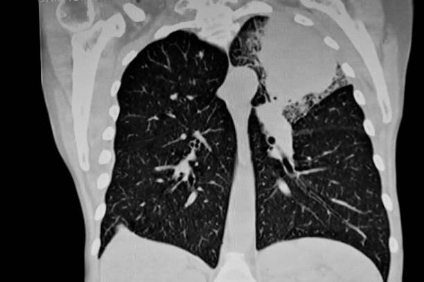 cat scan: left upper lung tumor - human upper body xray imagens e fotografias de stock