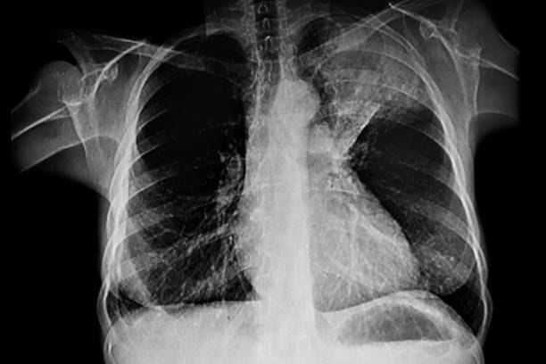 x - ray of left upper lung tumor - human upper body xray imagens e fotografias de stock