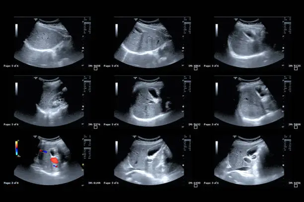 Photo of Ultrasound upper abdomen showing  Liver and gall bladder for screening hepatic cell carcinoma.