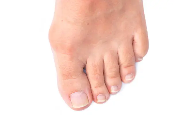 Feet of a woman with painful Hallux Valgus