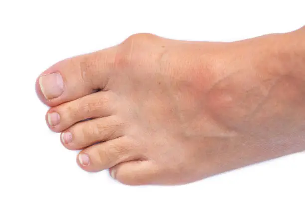 Feet of a woman with painful Hallux Valgus