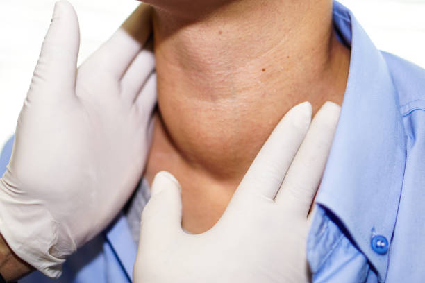 paziente donna asiatica ha un ingrossamento anomalo della ghiandola tiroidea ipertiroidismo (tiroide iperattiva) alla gola: sano concetto medico forte - goiter foto e immagini stock