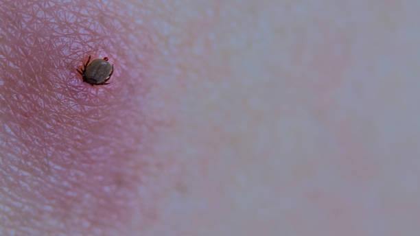 istock Sucking bloated deer tick. Human skin. Drop secretion. Ixodes ricinus 1146036092