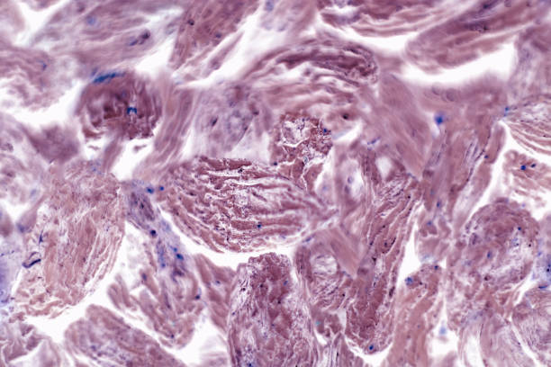istock Human squamous cell carcinoma. Tissues affected by cancer cells under a microscope. 1146057121
