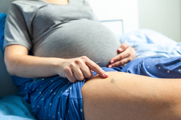 spataderen bij zwangere vrouwen. vrouw zit op een bed en wijst haar vinger op gezwollen aderen - woman legs veins stockfoto's en -beelden