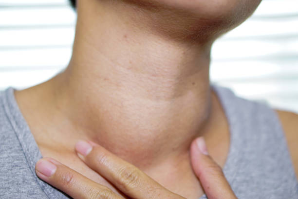 Asian lady woman patient have abnormal enlargement of thyroid gland Hyperthyroidism (overactive thyroid) at the throat : healthy strong medical concept stock photo