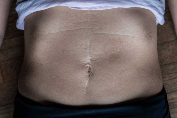 istock Surgical scar on woman's abdomen 1146324442