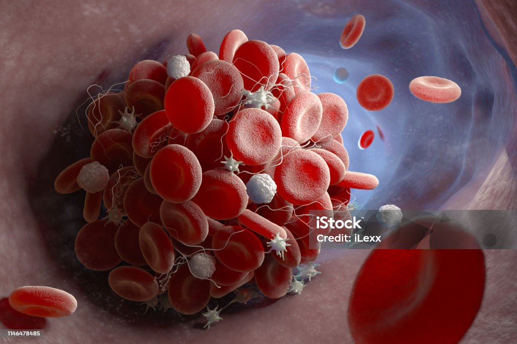 Formation of a blood clot Depiction of a blood clot forming inside a blood vessel. 3D illustration Blood Clot Stock Photo