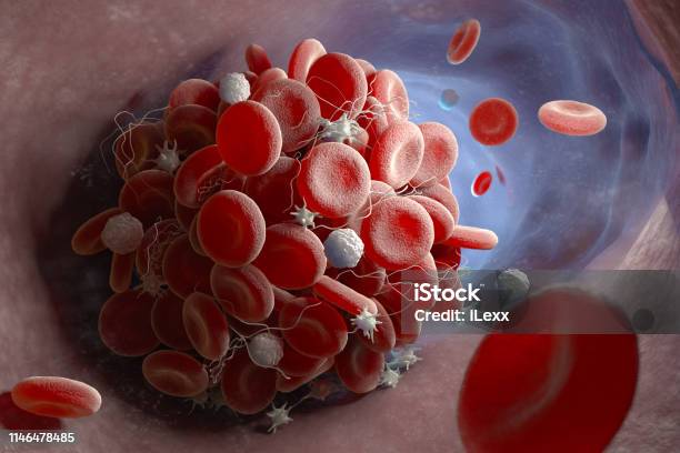 Formation Of A Blood Clot Stock Photo - Download Image Now - Blood Clot, Blood Cell, Blood Vessel