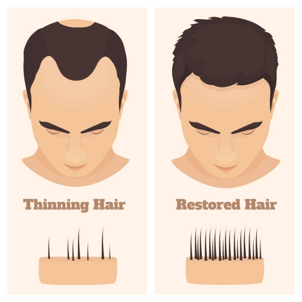 kuvapankkikuvitukset aiheesta miesten kuvio hiustenlähtösarja. lääketieteellinen koulutusjuliste. - receding hairline