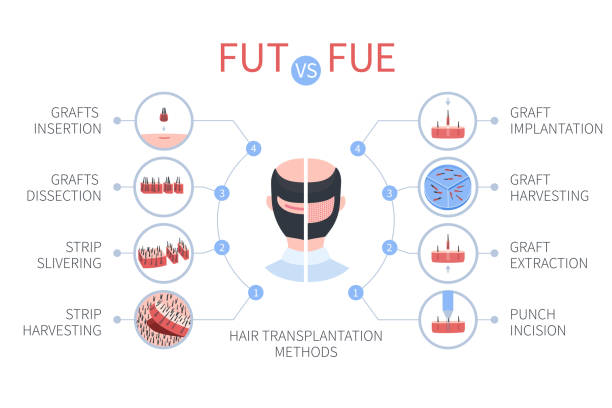 kuvapankkikuvitukset aiheesta fue vs fut hiustensiirron lääketieteelliset infografiikat - receding hairline