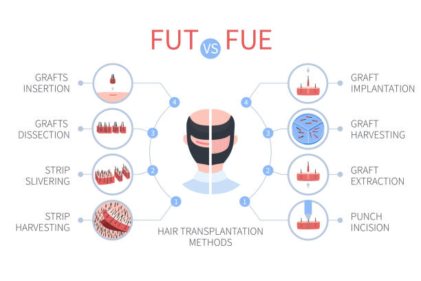 istock FUE vs FUT hair transplantation medical infographics 1146712761