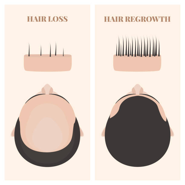 ilustrações, clipart, desenhos animados e ícones de homem antes e depois do rebrota do cabelo - alopecia homem
