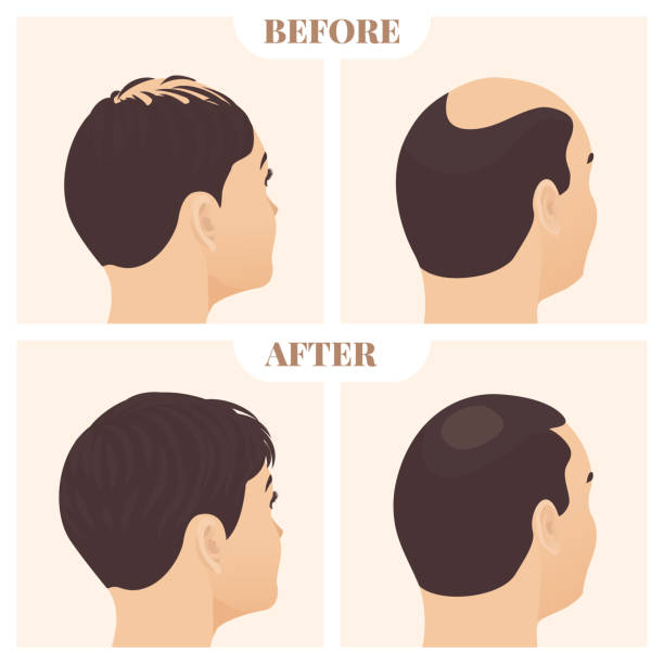 ilustrações, clipart, desenhos animados e ícones de homem e mulher na vista lateral antes e depois do tratamento da perda de cabelo - alopecia homem