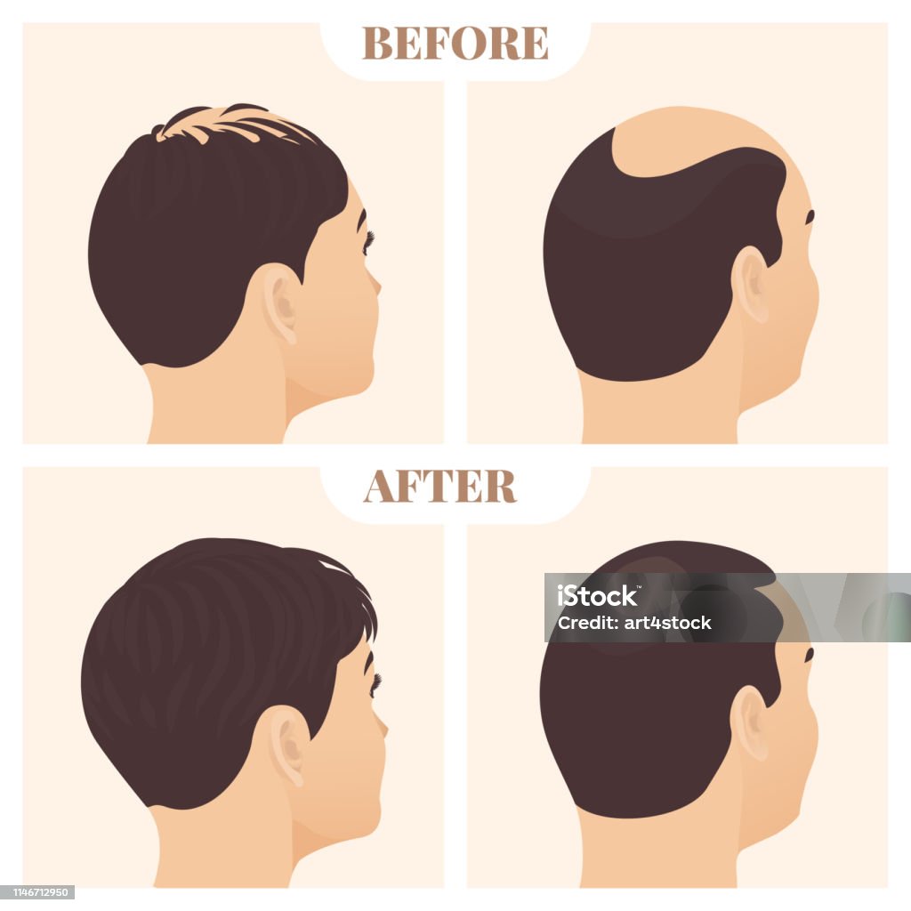 Man And Woman In Side View Before And After Hair Loss Treatment Stock  Illustration - Download Image Now - iStock