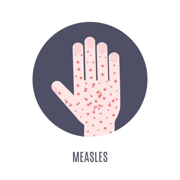 Measles rash on a hand medical icon Measles infection awareness medical poster. Hand covered with rash red spots. Virus symptom symbol. Vector illustration. measles illustrations stock illustrations