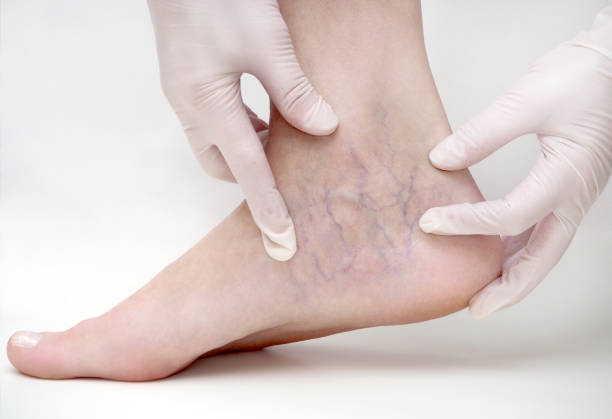 spider veins on the womans legs, sclerotherapy treatment - animal vein fotos imagens e fotografias de stock