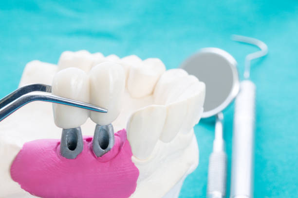 istock Close up implant and prosthodontic model. 1147229865