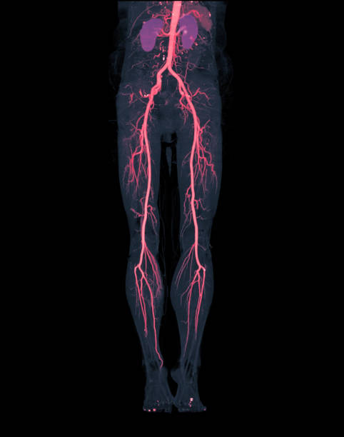 a artéria femoral de cta corre fora da imagem de 3d mip (vermelho) da artéria femoral com o rim para os pacientes que apresentam com doença arterial periférica aguda ou crônica. - computed - fotografias e filmes do acervo