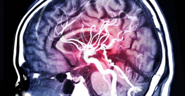 risonanza magnetica cervello o risonanza magnetica angiografia (mri) del vaso nella vista sagittale cerebrale. - brain surgery healthcare and medicine brain surgery foto e immagini stock