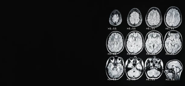 banner. mri of the brain of a healthy person on a black background with gray backlight. on the left place under the advertising inscription. - brain mri scanner mri scan medical scan imagens e fotografias de stock