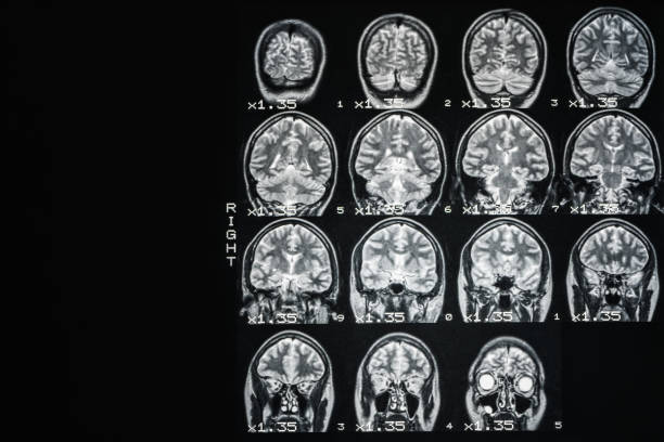 mri of the brain of a healthy person on a black background with gray backlight. medical background - brain mri scanner mri scan medical scan imagens e fotografias de stock