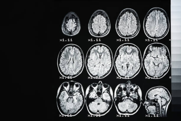 mri do cérebro de uma pessoa saudável em um fundo preto com luminoso cinzento. fundo médico - medical equipment mri scanner mri scan hospital - fotografias e filmes do acervo