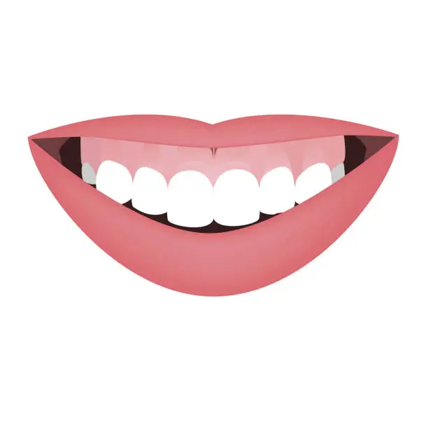 Vector illustration of Mouth with a distal bite and high smile line or gummy smile before the orthotropics or orthotropics treatment. Vector illustration