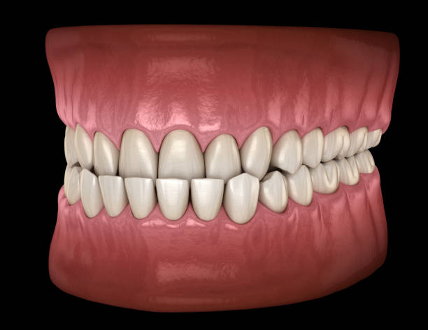 istock Underbite dental occlusion ( Malocclusion of teeth ). Medically accurate tooth 3D illustration 1147537884