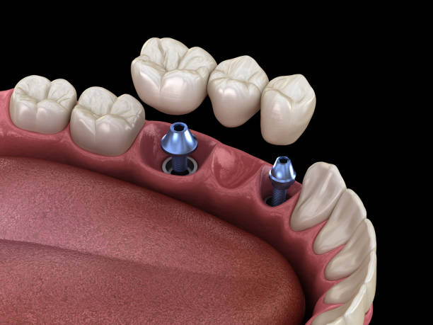 istock Dental bridge supported by implants. Medically accurate 3D illustration of human teeth and dentures concept 1147537918