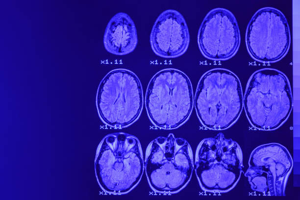 resonancia magnética del cerebro sobre un fondo negro con retroiluminación azul. lugar izquierdo para la inscripción publicitaria - artificial true exam blue fotografías e imágenes de stock
