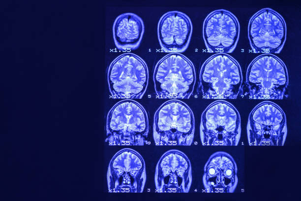 mri of the brain on a black background with blue  backlight. left place for advertising inscription - brain mri scanner mri scan medical scan imagens e fotografias de stock